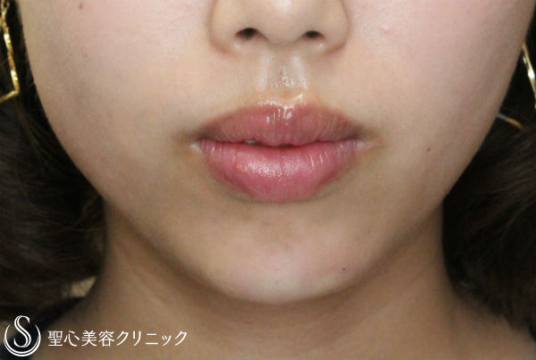 【20代女性・ヒアルロン酸で小顔に】クレヴィエル・コントア注入 After 