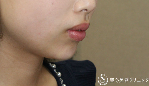 【20代女性・ヒアルロン酸で小顔に】クレヴィエル・コントア注入 After 