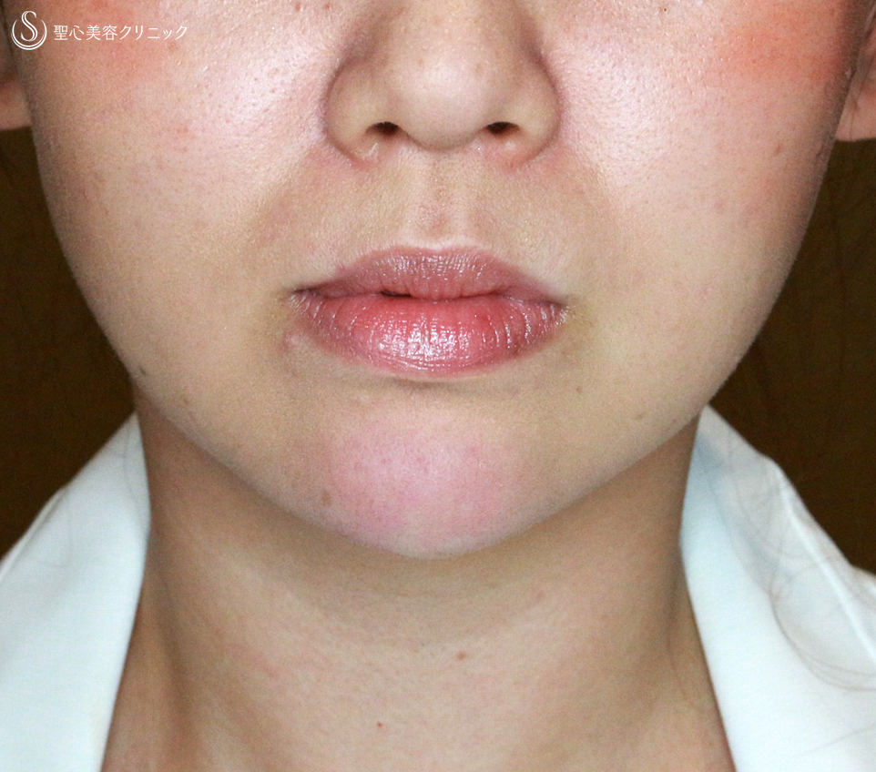 【30代女性・アゴヒアルで小顔＆美人顔】クレヴィエル・コントア（注入直後） After 