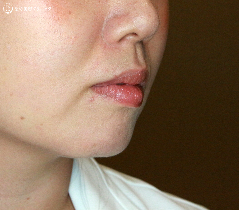 【30代女性・アゴヒアルで小顔＆美人顔】クレヴィエル・コントア（注入直後） Before 