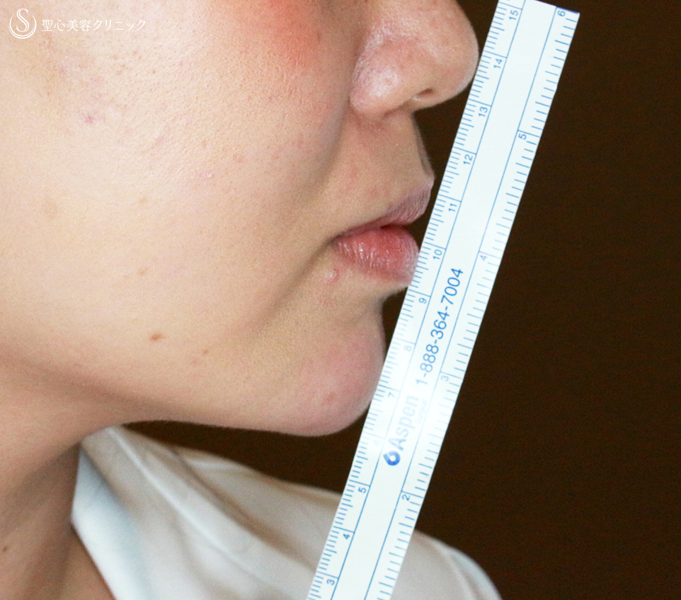 【30代女性・アゴヒアルで小顔＆美人顔】クレヴィエル・コントア（注入直後） After 