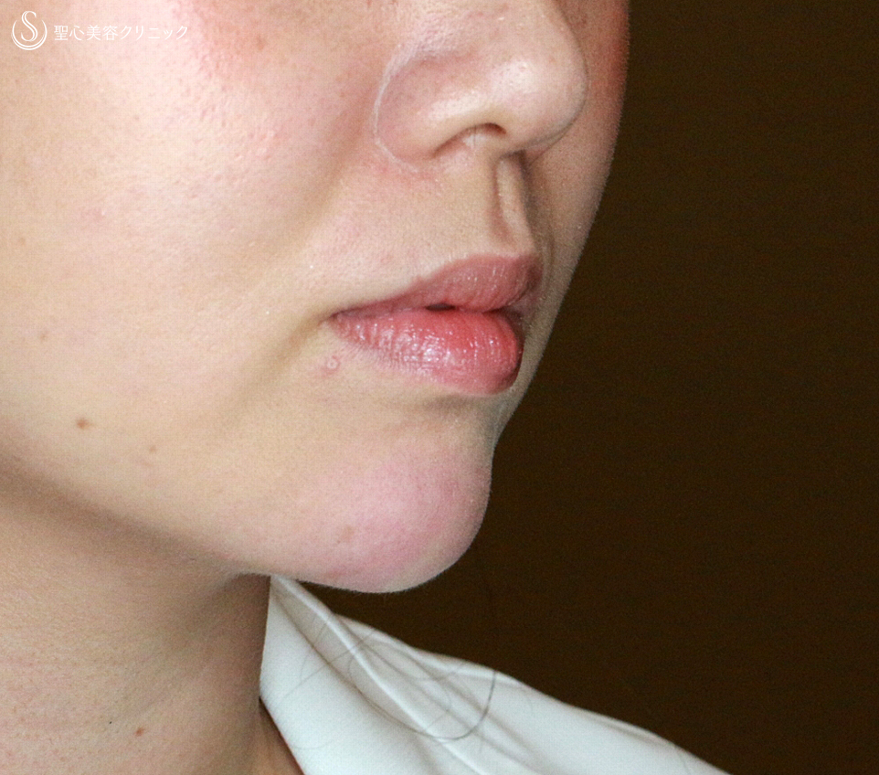 【30代女性・アゴヒアルで小顔＆美人顔】クレヴィエル・コントア（注入直後） After 