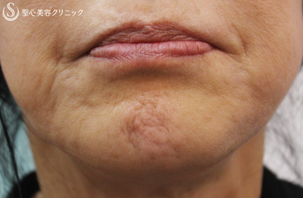 【60代女性・顎の梅干しジワ】ボトックスビスタ（1ヶ月後） Before 