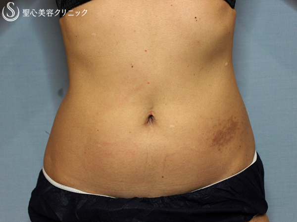 【40代女性・腹部の脂肪】APTS＋キャビテーションシェイプ（処置6回後） After 