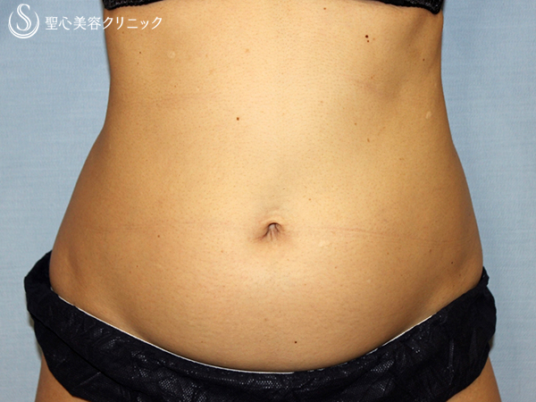 【40代女性・腹部の脂肪】APTS＋キャビテーションシェイプ（処置6回後） Before 
