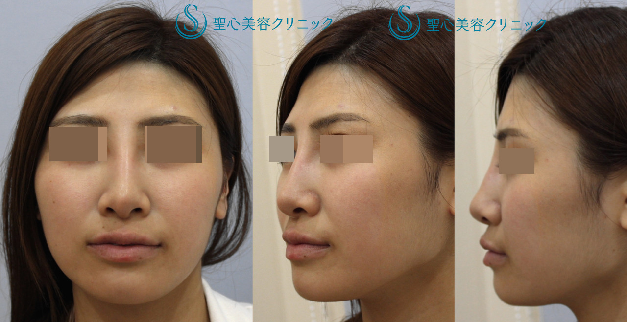 【20代女性・西洋人風のしっかりした鼻筋に】Ｉ型シリコンプロテーゼ＋鼻先～鼻柱耳介軟骨移植 After 