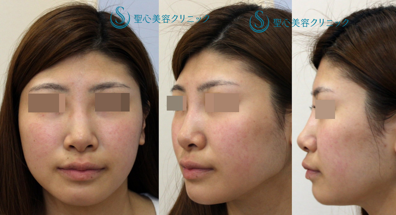 【20代女性・西洋人風のしっかりした鼻筋に】Ｉ型シリコンプロテーゼ＋鼻先～鼻柱耳介軟骨移植 Before 