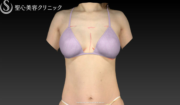 【女性・豊胸、バックから幹細胞脂肪注入へ】セリューション豊胸術（施術直後） Before 