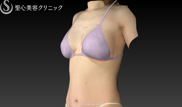 【女性・豊胸、バックから幹細胞脂肪注入へ】セリューション豊胸術（施術直後） Before 