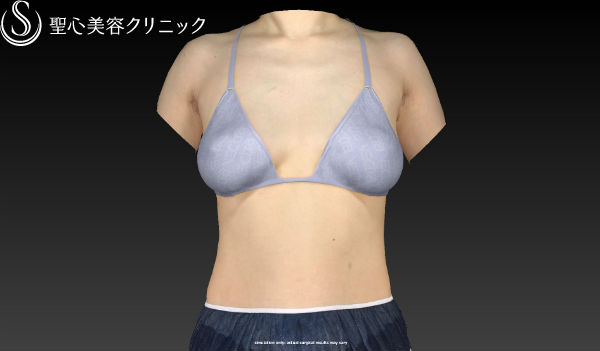 【女性・豊胸、バックから幹細胞脂肪注入へ】セリューション豊胸術（施術直後） After 