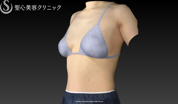 【女性・豊胸、バックから幹細胞脂肪注入へ】セリューション豊胸術（施術直後） After 