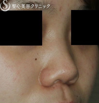 【20代女性・鼻筋の注入】長期持続型ヒアルロン酸 クレヴィエル・コントア（直後） Before 