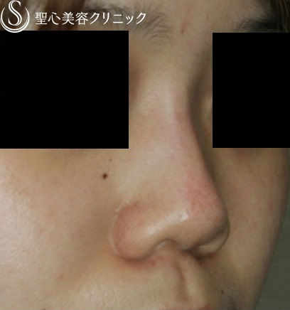 【20代女性・鼻筋の注入】長期持続型ヒアルロン酸 クレヴィエル・コントア（直後） After 