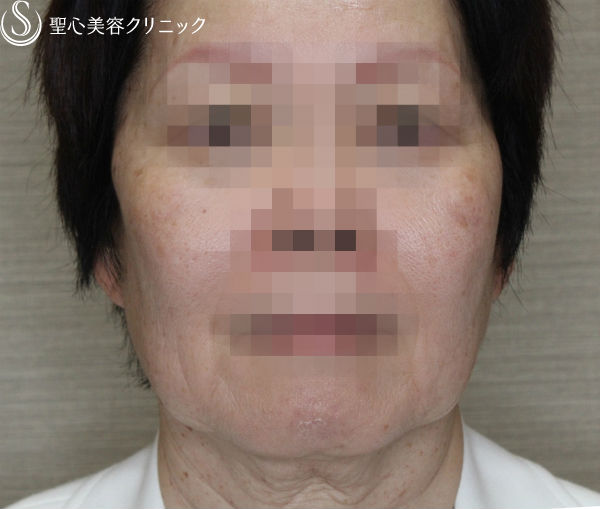 【50代女性・糸のリフトの組み合わせ】N-cogリフト＋スプリングスレッドリフト（1ヶ月後） Before 