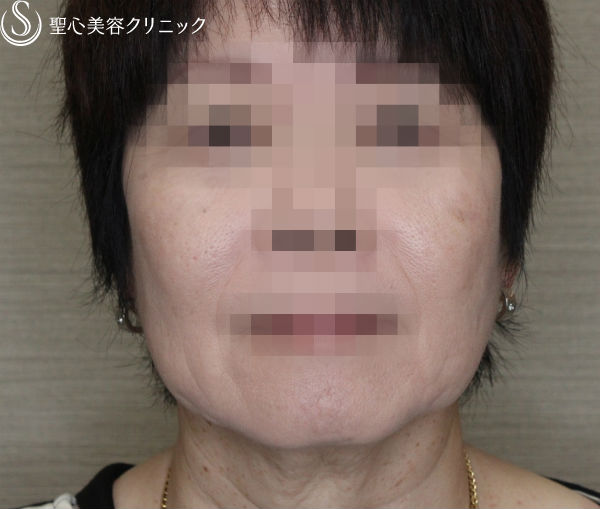 【50代女性・糸のリフトの組み合わせ】N-cogリフト＋スプリングスレッドリフト（1ヶ月後） After 