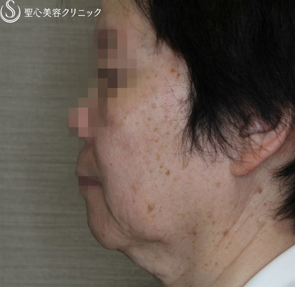 【50代女性・糸のリフトの組み合わせ】N-cogリフト＋スプリングスレッドリフト（1ヶ月後） Before 
