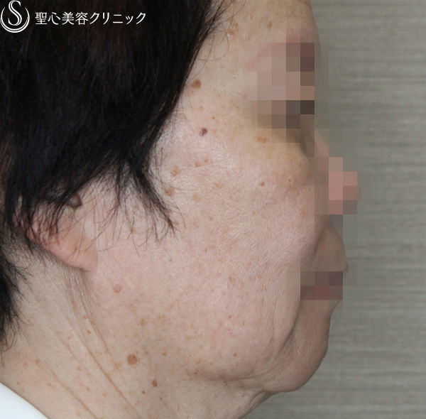 【50代女性・糸のリフトの組み合わせ】N-cogリフト＋スプリングスレッドリフト（1ヶ月後） Before 