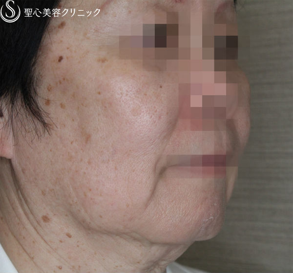 【50代女性・糸のリフトの組み合わせ】N-cogリフト＋スプリングスレッドリフト（1ヶ月後） Before 