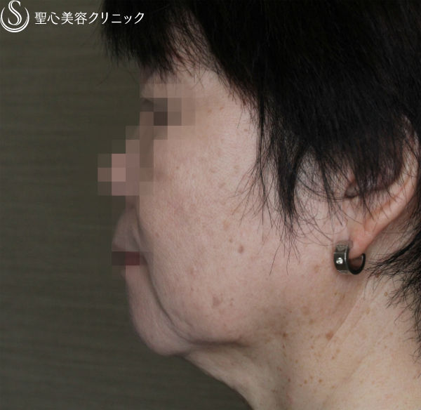 【50代女性・糸のリフトの組み合わせ】N-cogリフト＋スプリングスレッドリフト（1ヶ月後） After 