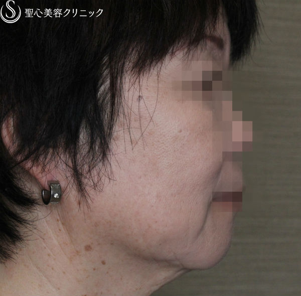 【50代女性・糸のリフトの組み合わせ】N-cogリフト＋スプリングスレッドリフト（1ヶ月後） After 
