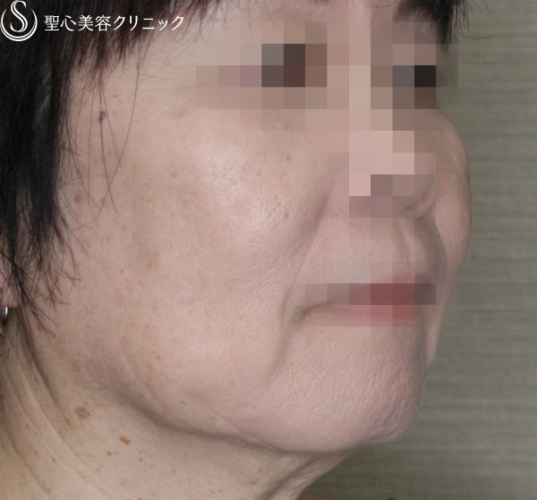 【50代女性・糸のリフトの組み合わせ】N-cogリフト＋スプリングスレッドリフト（1ヶ月後） After 