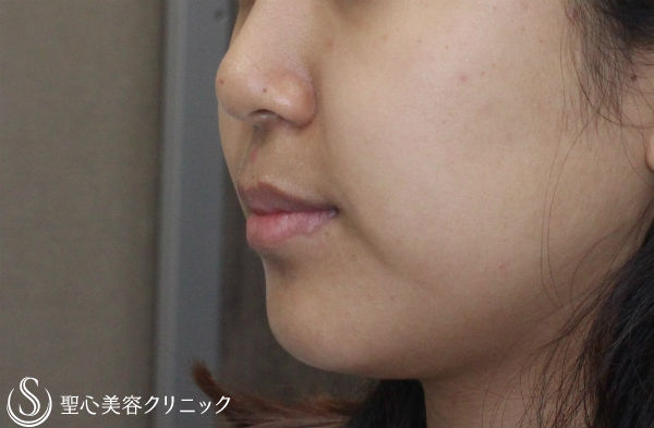 【20代女性・フェイスラインをスッキリと】ベイザー脂肪吸引（６ヶ月後） Before 