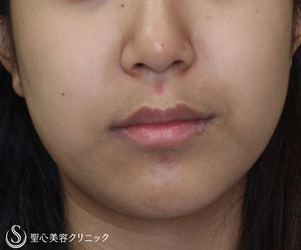 【20代女性・フェイスラインをスッキリと】ベイザー脂肪吸引（６ヶ月後） Before 