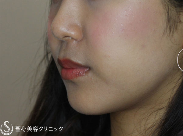 【20代女性・フェイスラインをスッキリと】ベイザー脂肪吸引（６ヶ月後） After 
