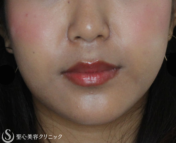【20代女性・フェイスラインをスッキリと】ベイザー脂肪吸引（６ヶ月後） After 