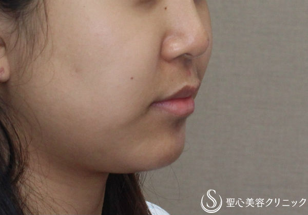 【20代女性・フェイスラインをスッキリと】ベイザー脂肪吸引（６ヶ月後） Before 