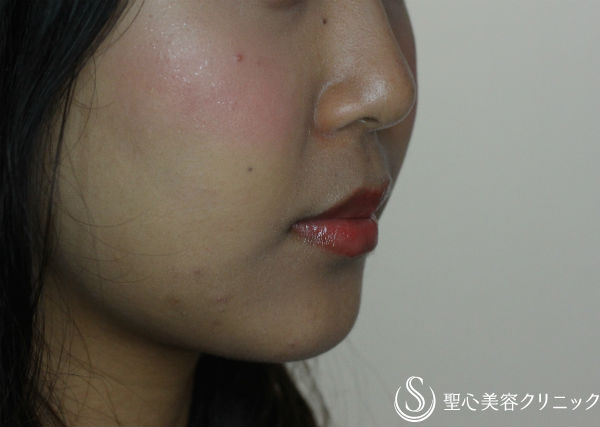 【20代女性・フェイスラインをスッキリと】ベイザー脂肪吸引（６ヶ月後） After 