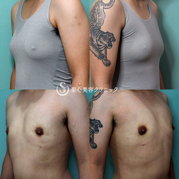 【２０代】FTM（性同一性障害）乳房切除 After 