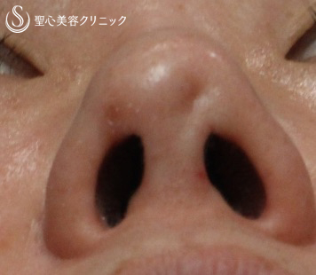 【40代女性・鼻の陥没修正】　（プロテーゼ後の修正） Before 