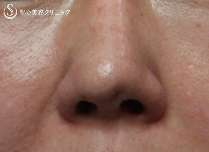 【40代女性・鼻の陥没修正】　（プロテーゼ後の修正） Before 