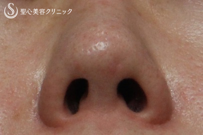 【40代女性・鼻の陥没修正】　（プロテーゼ後の修正） After 
