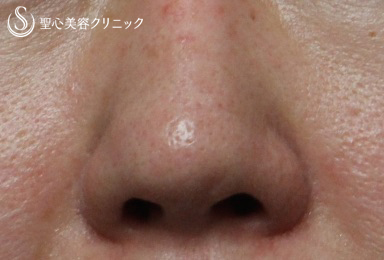 【40代女性・鼻の陥没修正】　（プロテーゼ後の修正） After 
