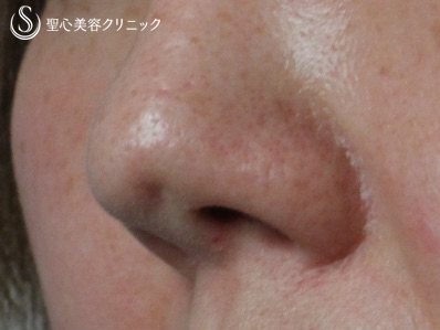 【40代女性・鼻の陥没修正】　（プロテーゼ後の修正） Before 