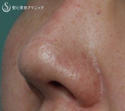【40代女性・鼻の陥没修正】　（プロテーゼ後の修正） After 