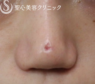 【20代女性・鼻の陥没修正】鼻尖縮小（他院修正） Before 