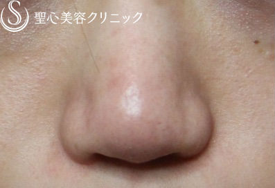 【20代女性・鼻の陥没修正】鼻尖縮小（他院修正） After 