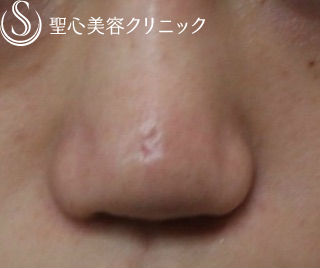 【20代女性・鼻の陥没修正】鼻尖縮小（他院修正） Before 