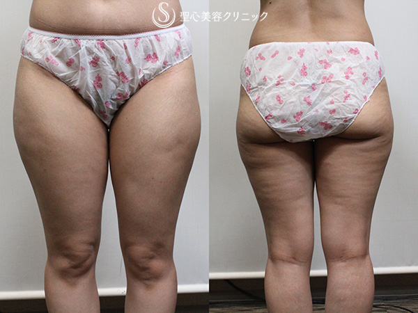 【40代女性・太もも】ベイザー脂肪吸引（1か月後） Before 