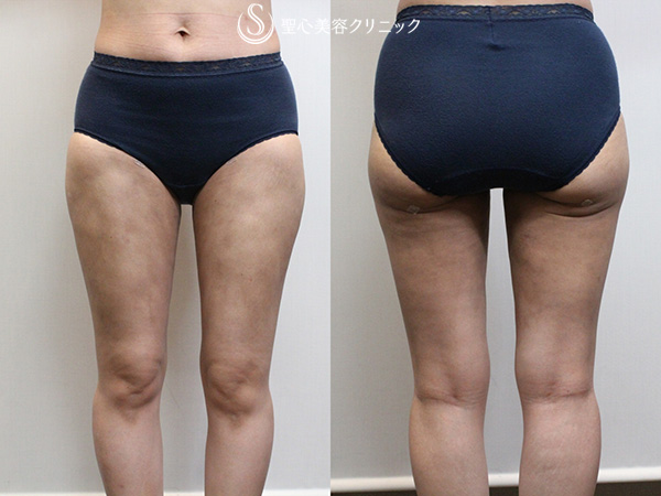 【40代女性・太もも】ベイザー脂肪吸引（1か月後） After 