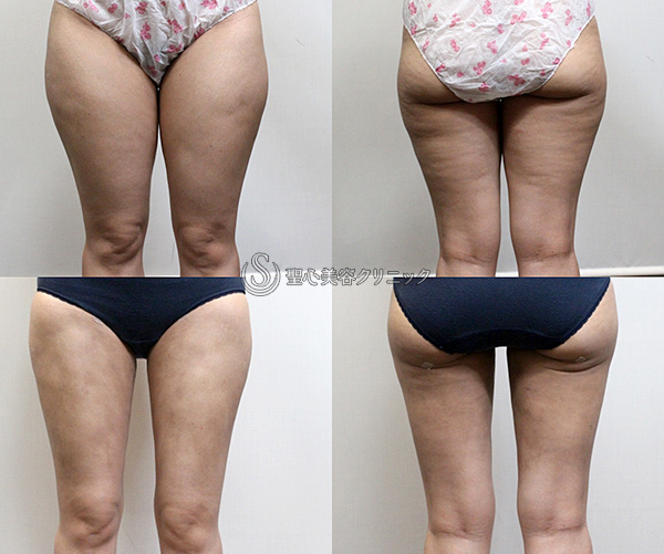 【40代女性・太もも】ベイザー脂肪吸引（1か月後） After 