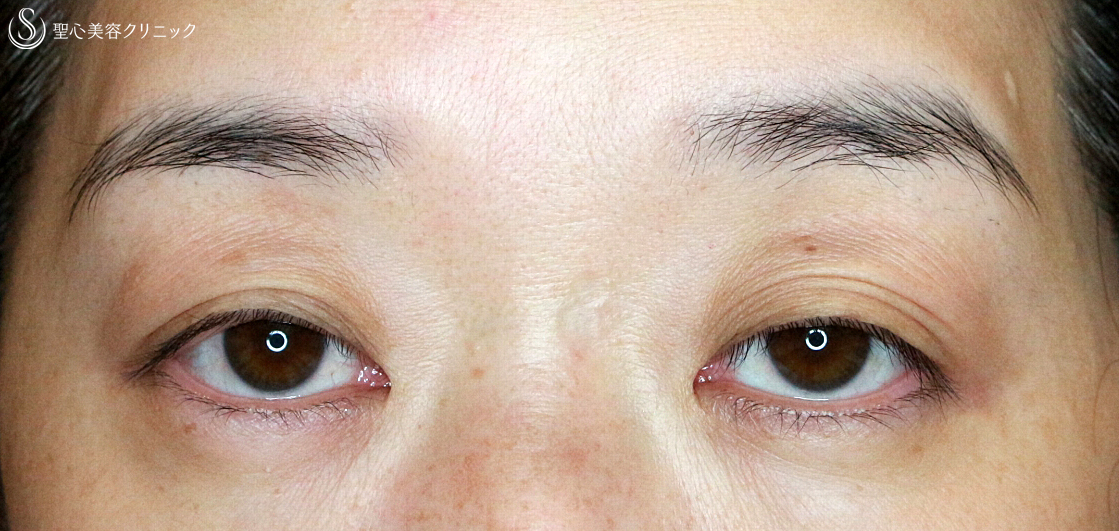 【40代女性・同じ糸で眼瞼下垂と二重（長期経過）＆瞼のタルミ】切らない眼瞼下垂+α法（6年後）眉下リフト（6ヶ月後） Before 