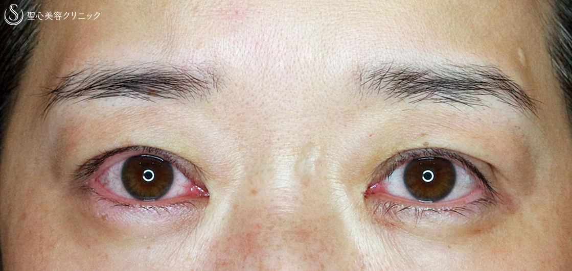 【40代女性・同じ糸で眼瞼下垂と二重（長期経過）＆瞼のタルミ】切らない眼瞼下垂+α法（6年後）眉下リフト（6ヶ月後） Before 