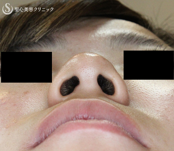 【20代女性・鼻先をスッキリと】鼻先修正単独・術後1週間 Before 