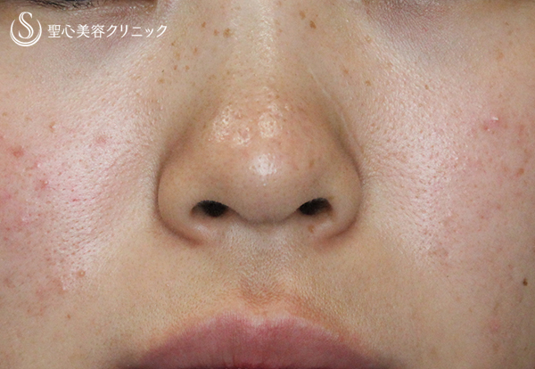 【20代女性・鼻先をスッキリと】鼻先修正単独・術後1週間 Before 