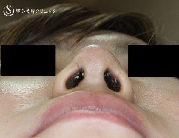代女性 鼻先をスッキリと 鼻先修正単独 術後1週間 症例写真 美容整形 美容外科なら聖心美容クリニック
