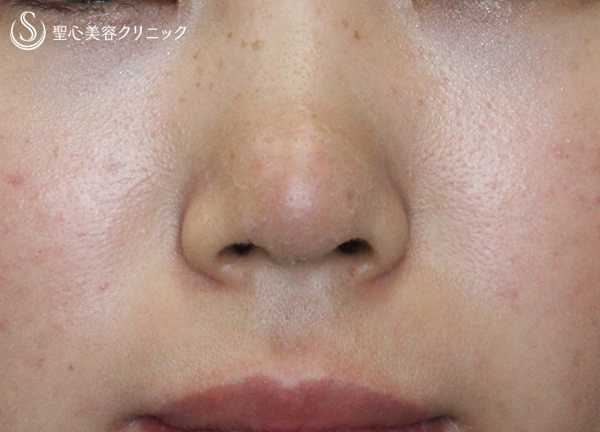 【20代女性・鼻先をスッキリと】鼻先修正単独・術後1週間 After 